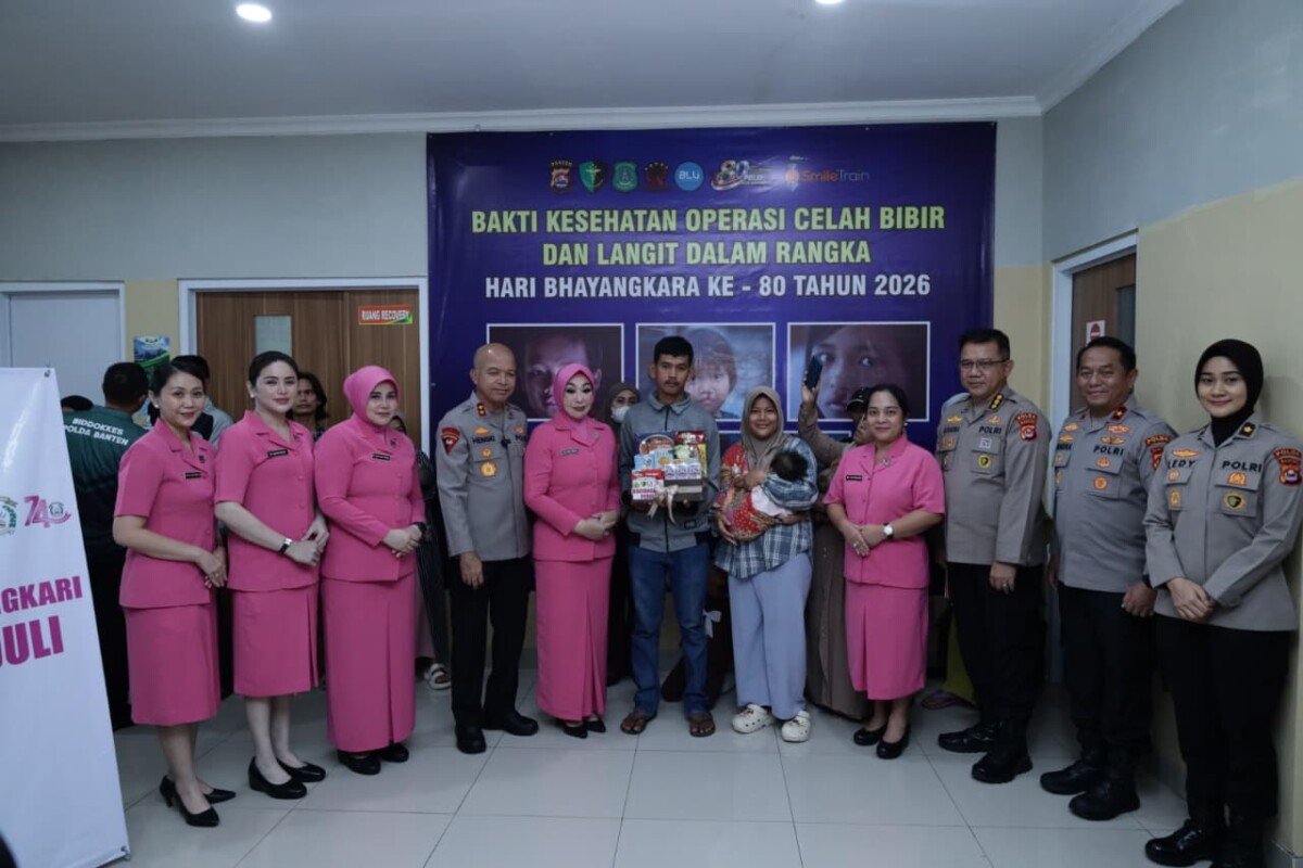 Sambut HUT Bhayangkara ke-80, Polda Banten Wujudkan Harapan 25 Anak Melalui Operasi Bibir Sumbing